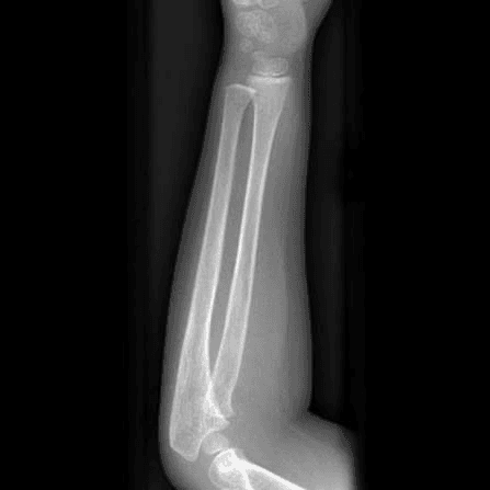 Forearm (Radius/Ulna)